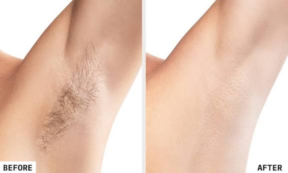 Before and after laser hair reduction result - Case 1