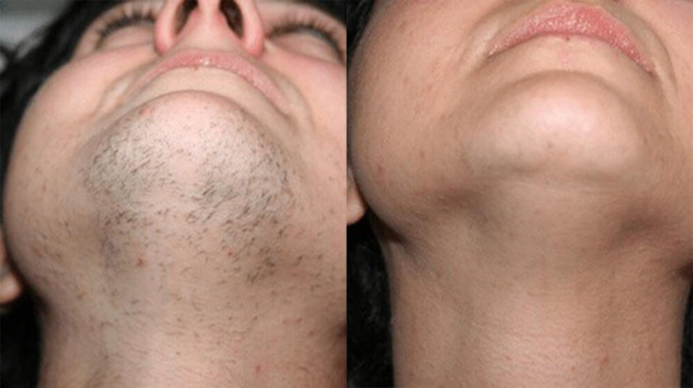 Before and after laser hair reduction result - Case 2