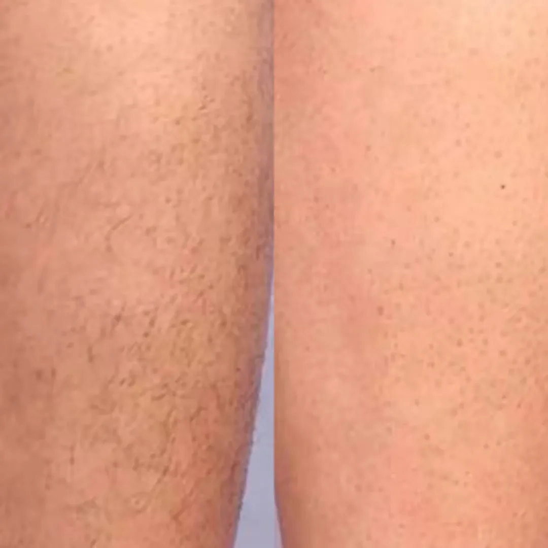 Before and after laser hair reduction result - Case 3